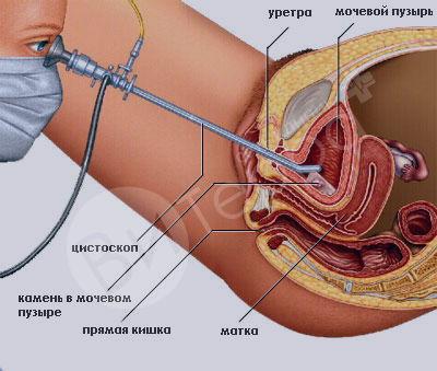 KidneyStone